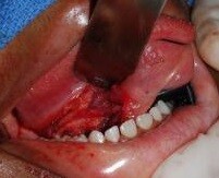 Κύστη στο έδαφος του Στόματος.ευίασις