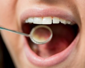 Στοματική Μυκητίαση.ent