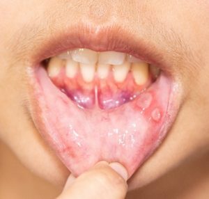 Αφδώδης Στοματίτιδα.ent