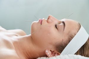 Trigeminal Neuralgia Acupuncture.eviasis