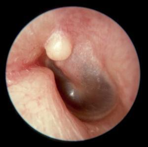 Εξοστώσεις.ent