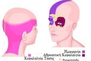 Assessment for Migraines.ent